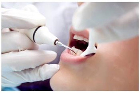 洗牙价格具体受以下几个条件影响:    1,洗牙费用取决于洁牙所使用